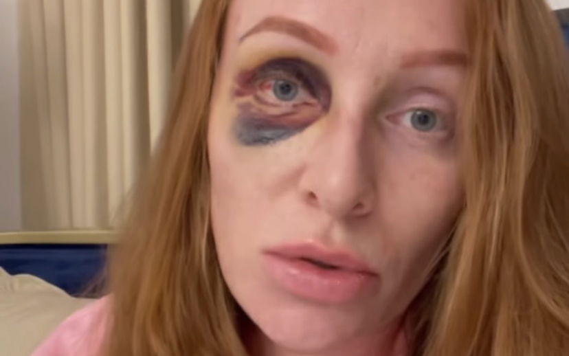 Georgina Fleur mit blauem Auge
