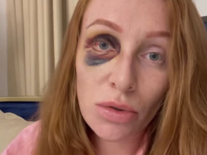 Georgina Fleur: Nasenbruch & blaues Auge - Prügel-Vorwurf gegen Kubilay!