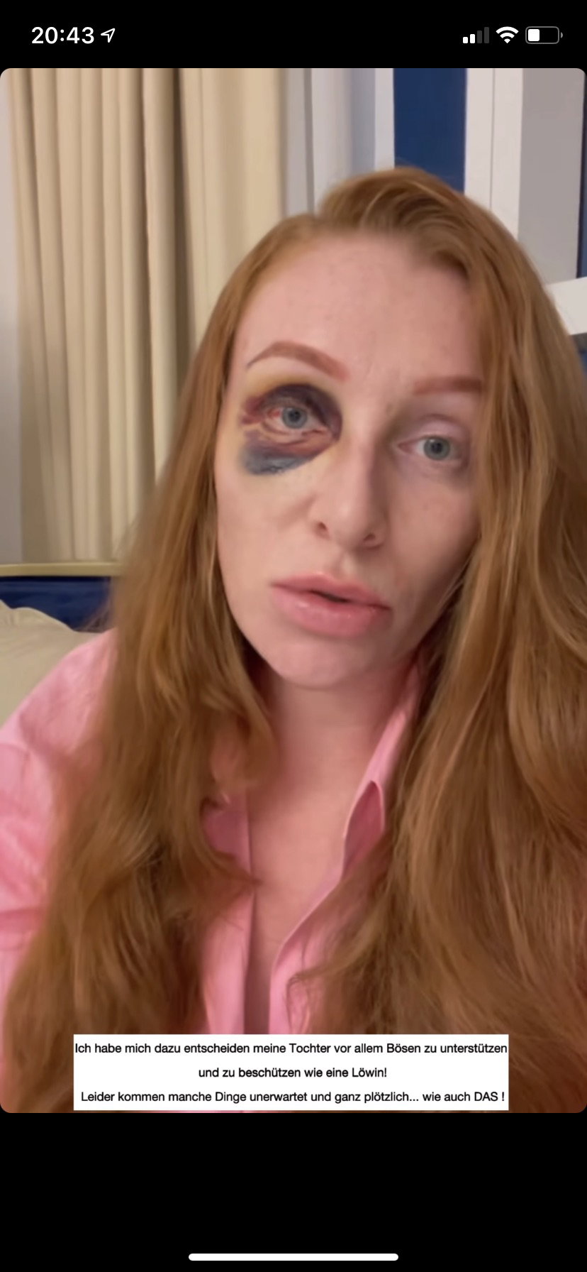 Georgina Fleur mit blauem Auge