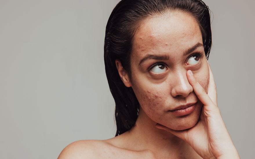 Hormonelle Akne von innen bekämpfen: So kannst du deine Pickel endlich heilen