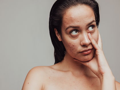 Hormonelle Akne von innen bekämpfen: So kannst du deine Pickel endlich heilen