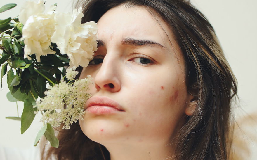 Retinol-Erstverschlimmerung: Was es mit Skin Purging auf sich hat