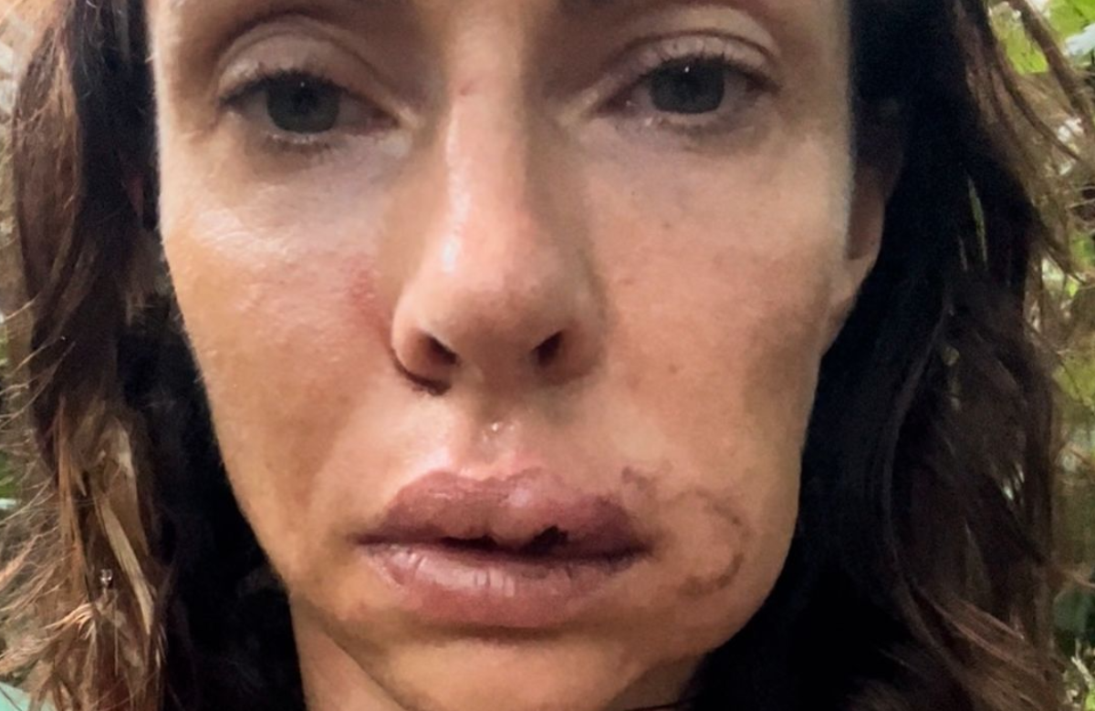 Jana Pallaske mit geschwollenem Gesicht