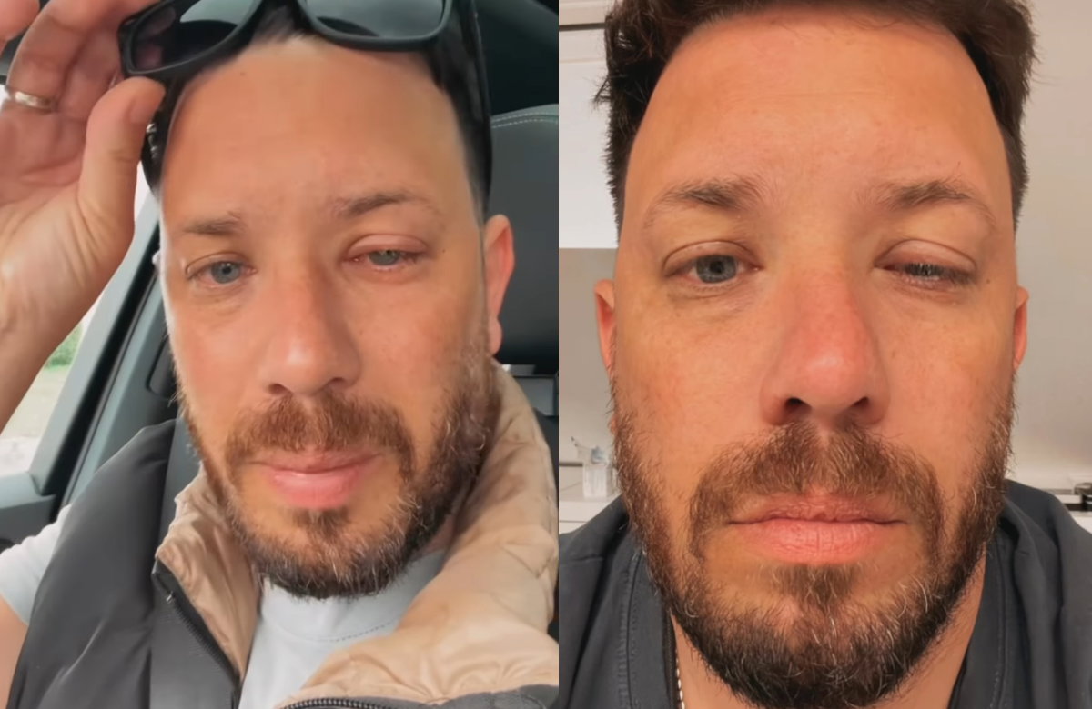 Florian Köster mit geschwollenem Auge