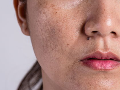 Creme gegen Pigmentflecken: Das ist das beste Produkt 