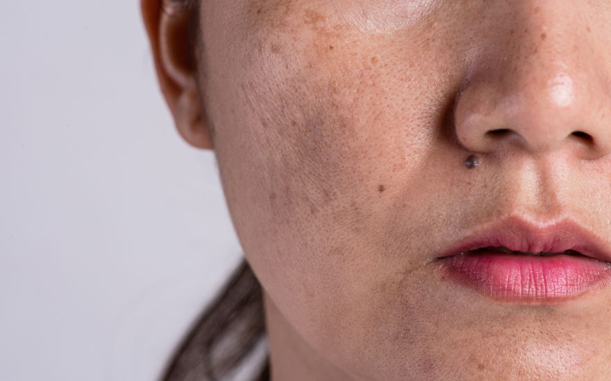 Frau mit Pigmentflecken im Gesicht