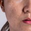 Creme gegen Pigmentflecken: Das ist das beste Produkt 