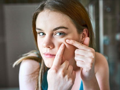 Azelainsäure: Superstar gegen Pickel