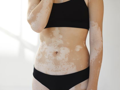 Weiße Flecken: Neue Therapie-Ansätze bei der Autoimmunkrankheit Vitiligo