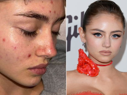 Leni Klum nach Akne-Foto: Für Expertin ein "großer Schritt im Hinblick auf Skin Positivity"