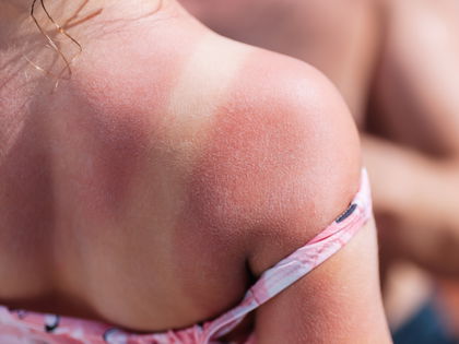 Hausmittel gegen Sonnenbrand: 5 SOS-Mittel für eine schnellere Linderung