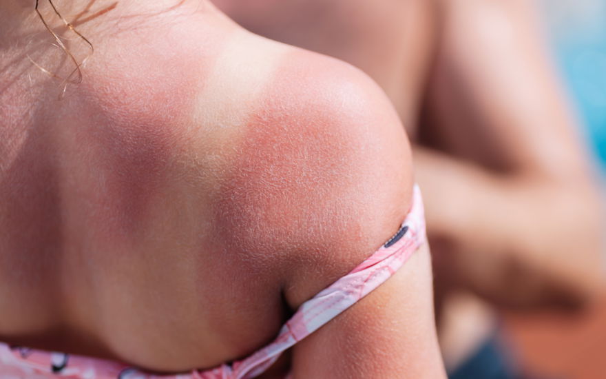 Sonnenbrand Hausmittel