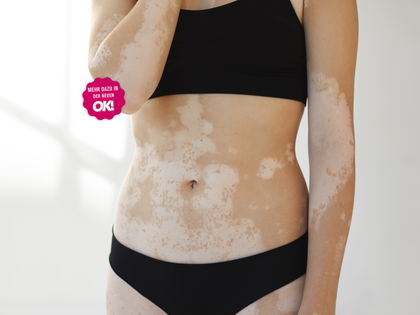 Weißfleckenkrankheit: Neues Medikament macht Vitiligo-Patienten Hoffnung