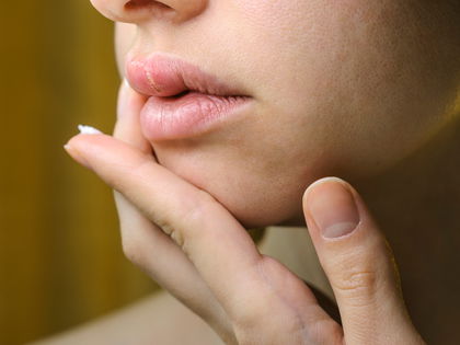 Hilfe, ist das etwa Herpes? Was du jetzt tun kannst