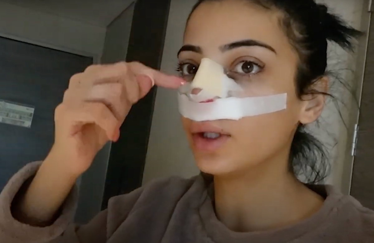 Dilara Kruse Ende 2023 nach ihrer Nasen-OP mit Verband