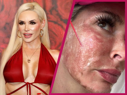 Daniela Katzenberger: Schock-Foto! Üble Verbrennungen nach Laser-Behandlung im Gesicht