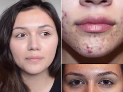 Mutiges Video - GNTM-Star Anna Maria Damm über Akne-Leiden - Model-Jobs abgesagt! Die Ex-Kandidatin über extreme Hautprobleme