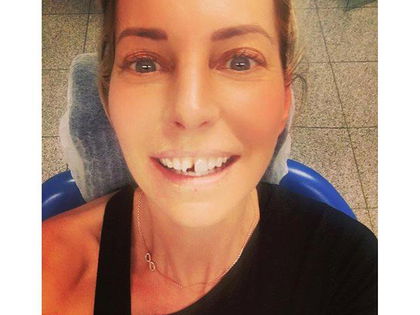 Nach fiesem Unfall: Giulia Siegel mit Zahnlücke! - Das Model hat sich mit einem Kleiderbügel verletzt