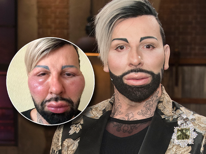 Harald Glööckler: Was ist mit seinem Gesicht passiert? - Der Designer postet Schockfotos