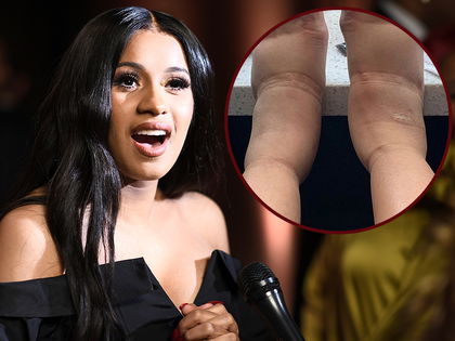 Cardi-B: Schock-Foto! Was ist mit ihren Füßen passiert? - Gefährdet sie ihre Gesundheit?