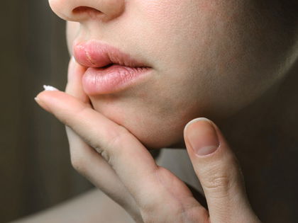 Herpes in 24 Stunden weg - So stoppst du die Vermehrung & bekämpfst die Symptome von Herpesbläschen