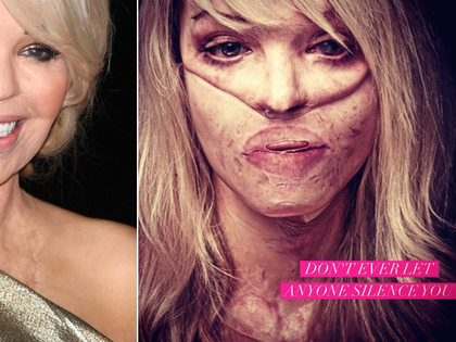 Säureopfer Katie Piper nach 110 OPs kaum wiederzuerkennen - Sechs Jahre später hat das Model ihr schönes Gesicht zurück